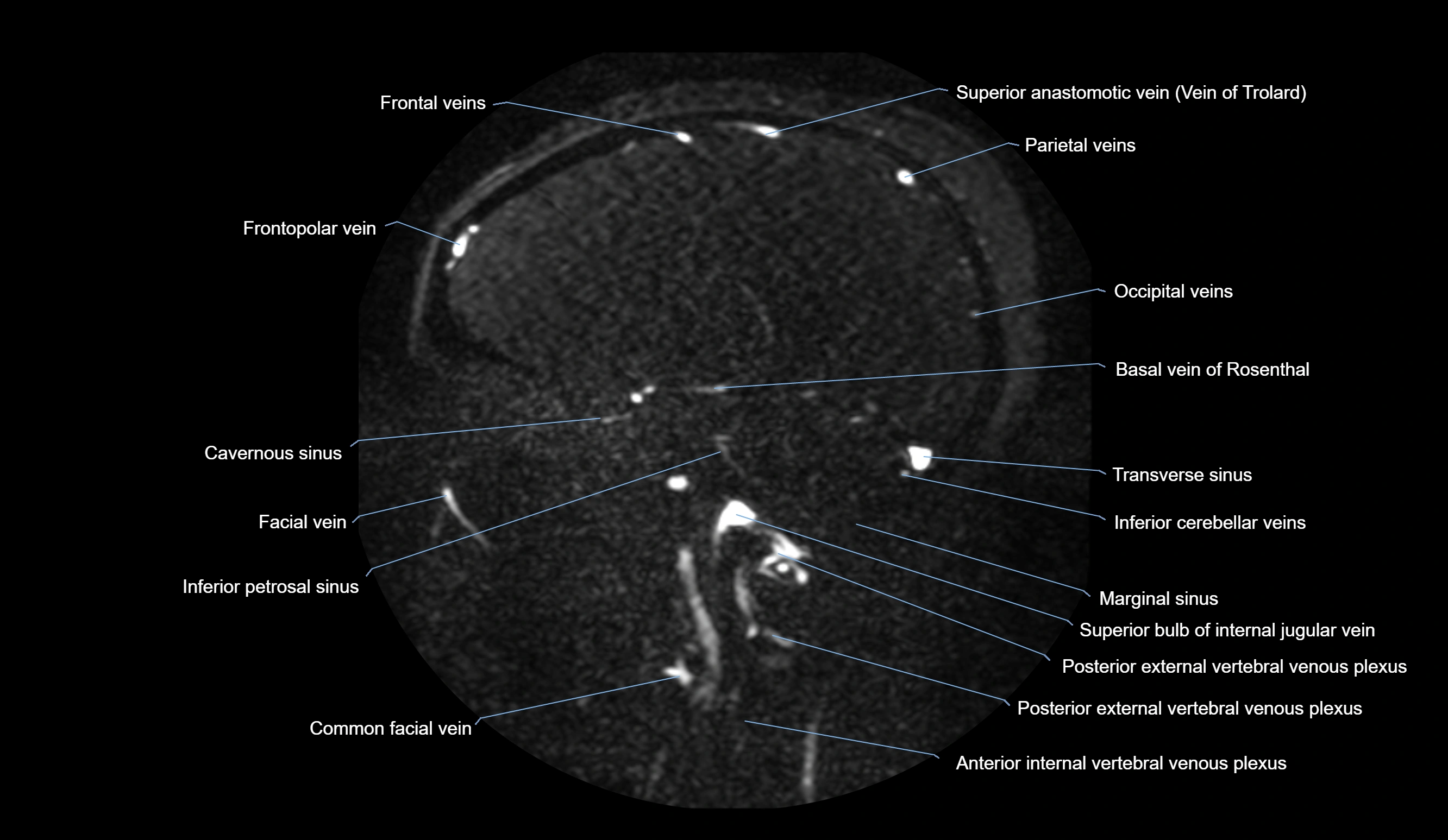 MRV brain sagittal anatomy 3T MRI images -img-01015-00054.webp